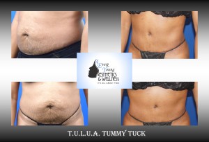 Atlanta Tummy Tuck, Tummy Tuck, also known as abdominoplasty, lipoabdominoplasty, liposuction tummy tuck, is a procedure to that corrects a rectus diasthasis and removes excess or poor quality skin from the abdomen. We combine our tummy tuck with liposuction in order to contour the body resulting in a flat stomach with scars that are placed low in the bikini line. Our liposuction is accomplished by either traditional tumescent liposuction, laser liposuction (Smartlipo), vaser liposuction with the use of a power assisted liposuction handle to remove fat more thoroughly and rapidly. We use abdominal liposuction, flank liposuction, back liposuction, arm liposuction, thigh liposuction and ankle liposuction to remove unsightly fat from problem areas with our tumescent liposuction procedures with or without sedation. If you desire we use autologous fat transfer (fat grafting) to use the fat obtained as the most natural dermal filler unlike synthetic fillers (Restylane, Juvederm, Sculptra, Radiesse, Belotero, Perlane) to improve fine lines and wrinkles of the face, hand rejuvenation with fat, fat transfer to breast, Brazilian Butt Lift (Butt Augmentation), liposculpture, lip augmentation with fat. Fat transfer to the breast can be a great alternative to breast augmentation, saline implants, silicone implants, breast augmentation with mastopexy or just to improve volume in the upper pole of the breast. Our autologous fat transfer is second to none and we utilize Platelet-Rich Plasma (PRP) which helps stabilize the fat transfer faster by promoting blood vessels to grow into the fat grafting. Most people think that a Brazilian butt lift (BBL) is a plastic surgery procedure but instead it is a cosmetic surgery procedure strictly performed for enhancement of the buttock area to transform your butt into the big Brazilian butt and replicate the popular Brazilian ass that Brazilian butt women have been getting Brazilian butt lifts to have for years. As part of our mommy makeover packages you can combine a Brazilian ass with a tummy tuck and/or breast augmentation with a mastopexy, which is more commonly associated with a mommy makeover, brazilian butt lift atlanta, atlanta brazilian butt lift, liposuction plastic surgery, liposuction, laser liposuction. fat grafting, brazilian ass, brazilian butt women, fat transfer, botox, plastic surgery, cosmetic surgery, plastic surgeon, cosmetic surgeon