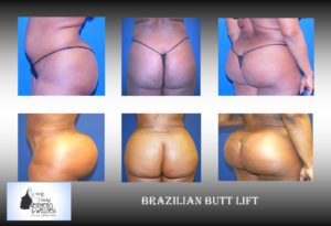 Brazilian Butt Lift Atlanta