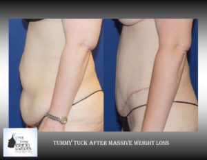 Tummy Tuck Plastic Surgery